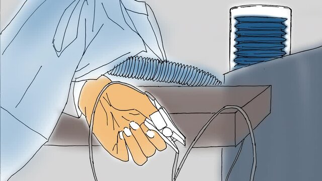 Intubated patient connected to an artificial lung ventilation unit.Patient's hand under anesthesia with a sensor on his finger.Freehand animation.