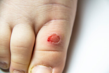 Callus on the leg of a young boy. children foot with problem areas on the skin, dry callus, bad nails. Leg wound from the callus.