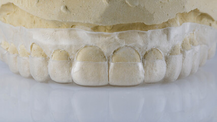 flexible dental cap for plastics of the upper jaw gums on a white background © Dental Pro Content