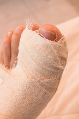 Close up of a Persons Bandaged up Broken Big Toe 