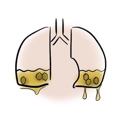 Honeycombs and honey in the lungs