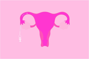 Vector illustration of intratubal insemination (ITI)