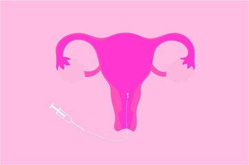 Vector illustration of intrauterine insemination (IUI)
