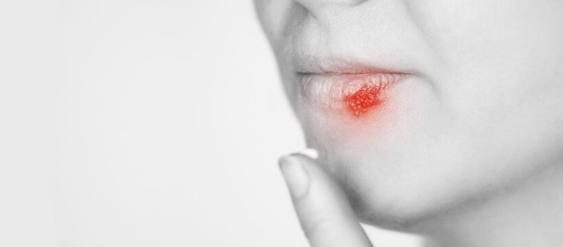 Zoster Bilder Durchsuchen 2,692 Archivfotos, und