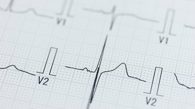 心臓の検査で記録された心電図の波形