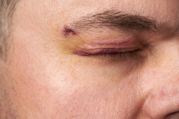 Fototapeta premium close view of a black eye, man's face with a hematoma