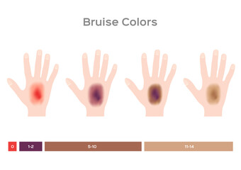 a little bit to serious bruised . It bleeding in side the skin