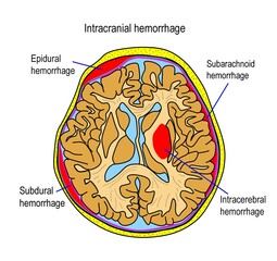 Four types of intracranial hemorrhage.