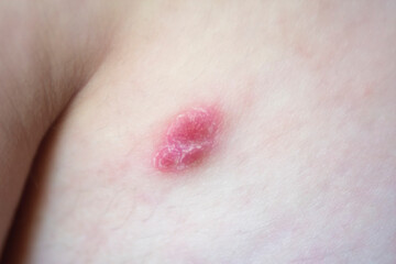 Fototapeta premium macro closeup of a Caucasian male patient shoulder with a Psoriasis skin lesion (first lesion)