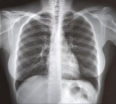 Chest x-ray for examination by a doctor, light infection, orthopedics and exclusion of injuries.