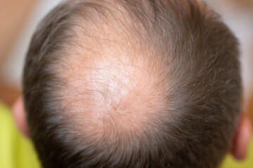 Hair losing concept. Close up view of a man's head.