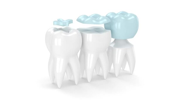 Teeth in jaw with three different types of dental filling