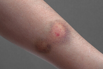 Close up of a colored bruise on a woman arm