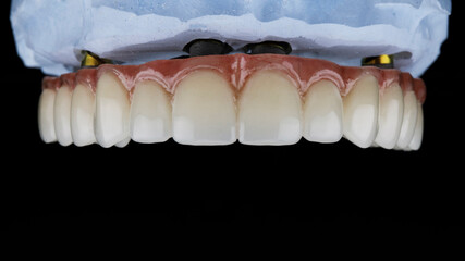 Dental prosthesis of the upper jaw with a pink gum on a model of plaster, shot on a black background © Dental Pro Content
