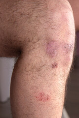 bruise and bruise on a man knee.