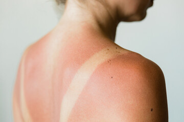 Close-up of a sunburn marks on a woman's back - obrazy, fototapety, plakaty