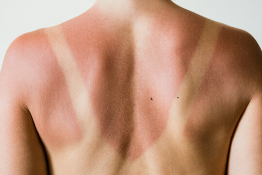 Close-up of a sunburn marks on a woman's back