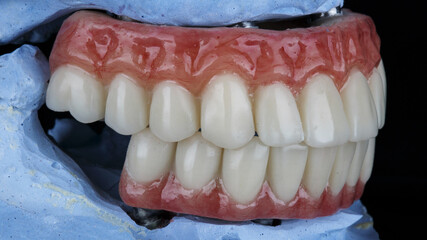 dental prostheses for the lower and upper jaws of the patient in the bite on a black background