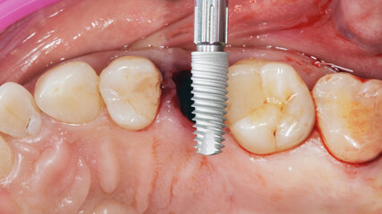 dental implant before installation in the bone for tooth restoration, dental photograph through a mirror during implantation