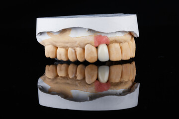 dental crown made of zircon mounted in a model of gypsum, shot on black glass with reflection