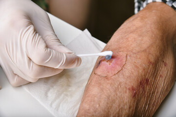 Wound dressing, Doctor applying medicine to infected wound in chronic diabetes senior patient,...
