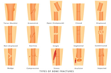 Types of fracture. Human Broken Bone. Different types of bone fractures. Types of bone fractures medical skeleton anatomy educational vector illustration about injury and disease on white background