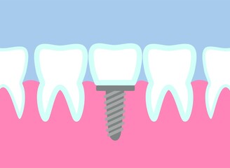 Dental implant vector illustration. Metal or titanium tooth pin installation. Orthodontic surgery. Replacement crown on teeth. Stomatology health care. Medical theme infographic.