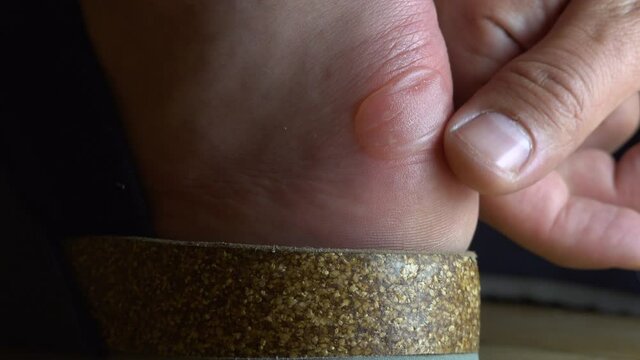 Terrible bladder on the heel. Hand touching painful blister skin on the feet. Painful wound with pus caused by new shoes