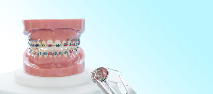 orthodontic model and dentist tool - demonstration teeth model of varities of orthodontic bracket or brace