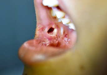Small  wound in buccal area due to injury in Asian, child.