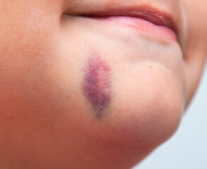 bruise on the skin of the face
