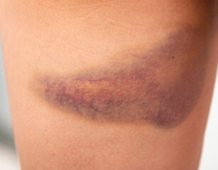 large bruise on the skin on the leg