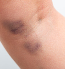 large bruise on the skin on the leg