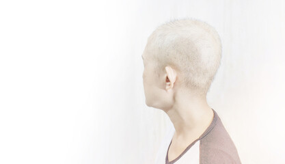 Woman's hair loss resulting from chemotherapy. Side effects from cancer. Breast cancer.