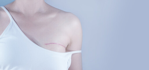 Breast cancer surgery scars by partial mastectomy.  She can wear a tube top or tube dress and strapless with confident. With effect filter.