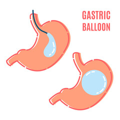 Gastric balloon non surgical weight loss procedure in stomach. Medical concept. Human body organ anatomy and health care. Vector illustration in flat style.