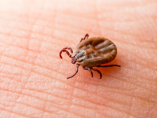 Lyme Disease Infected Tick Insect Crawling on Skin. Encephalitis Virus or Lyme Borreliosis Disease...