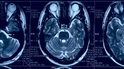 Brain MRI slide of a young man, toned