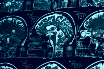 MRI scan of human brain