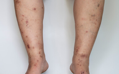 Scars from inflammation, infection on the skin of the legs.