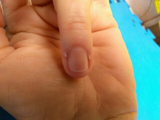 cuticle on finger