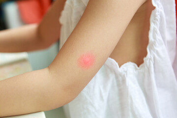 Obraz premium Little girl has skin rash and allergy from mosquito bite