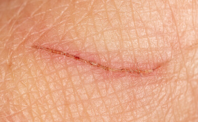 Close-up of blood from a wound on a human skin.