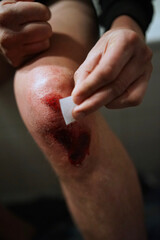 Cleaning fresh scratched knee wound with sterile wipe after accident, open wound with blood           
