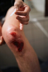 Scratched knee after accident, open wound with blood        