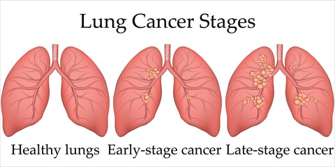 Vector medical illustration of human lung cancer development process. Stages of lung cancer from healthy lungs to the last stage. Poster for hospital or biology textbook.
