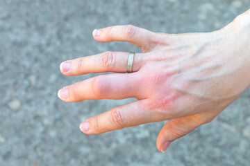 right hand with a swollen large middle finger after a bee bite with a wedding ring, enlarged in...
