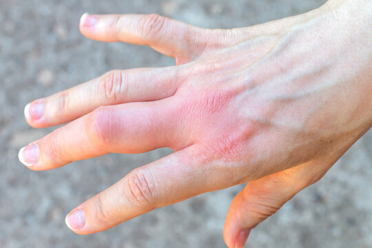 right hand with a swollen large middle finger after a bee bite, enlarged in size as a result of allergy reaction after a wasp sting, red sensation on palm, finger wounded, skin irritation,  necrosis