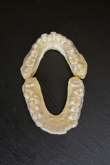 Plaster cast of teeth in the jaw of a person. A plaster cast of the teeth of future implants.