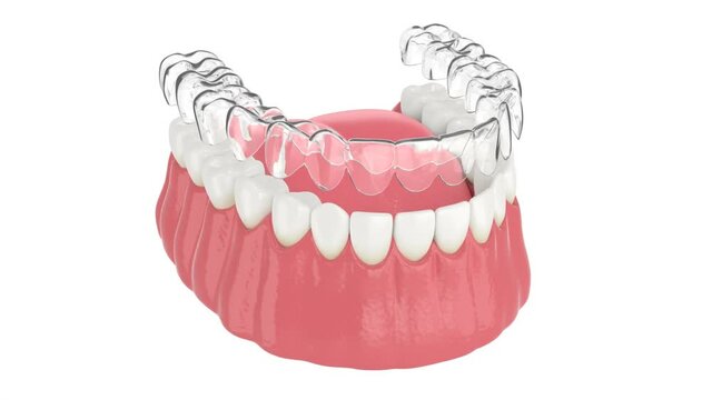 Invisalign removable and invisible retainer placement on lower jaw over white background